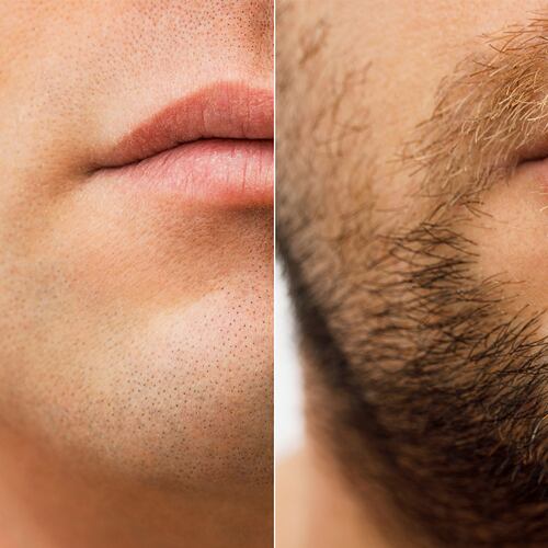 Minoxidil 5mg 50 Tabletas Minoxytop
