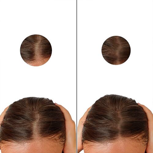 Minoxidil 5mg 50 Tabletas Minoxytop