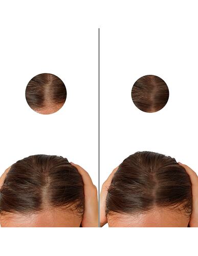Minoxidil 5mg 30 Tabletas Minoxipark
