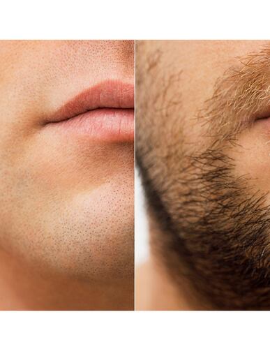Minoxidil 5mg 30 Tabletas Minoxipark
