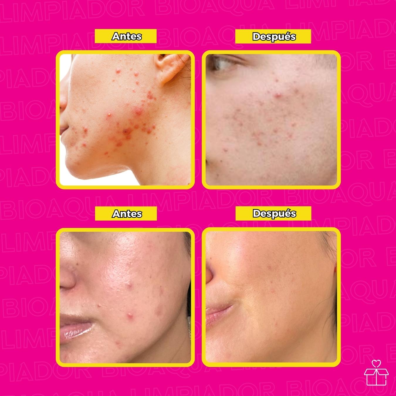 Limpiador Facial Elimina Acné.