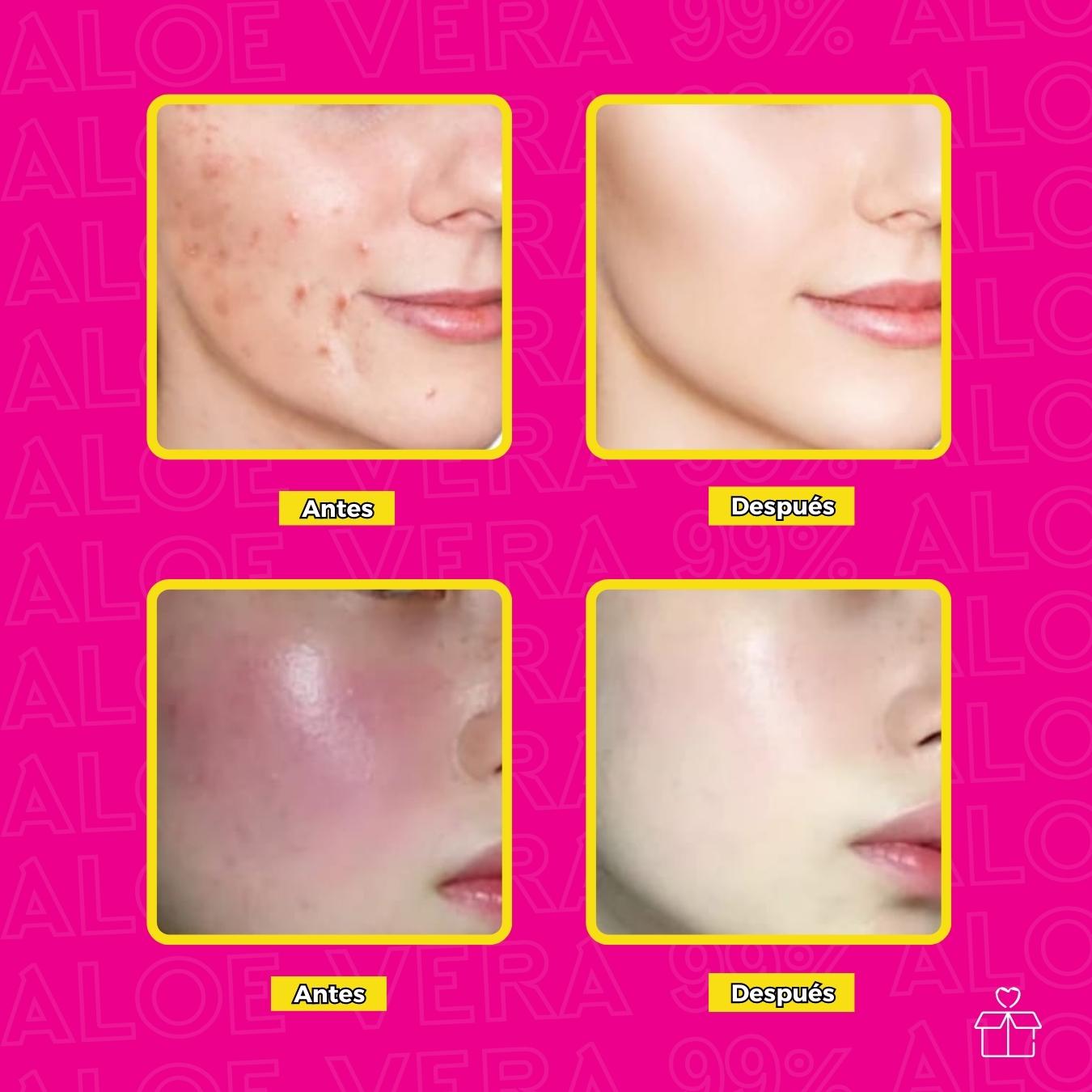 Gel Aloe Vera Sábila Facial 3 Unidades