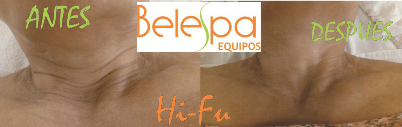 Mini Hifu Portatil Rejuvenecimiento Lifting  Facial 