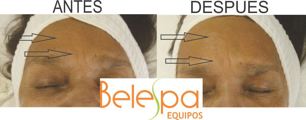 Mini Hifu Portatil Rejuvenecimiento Lifting  Facial 