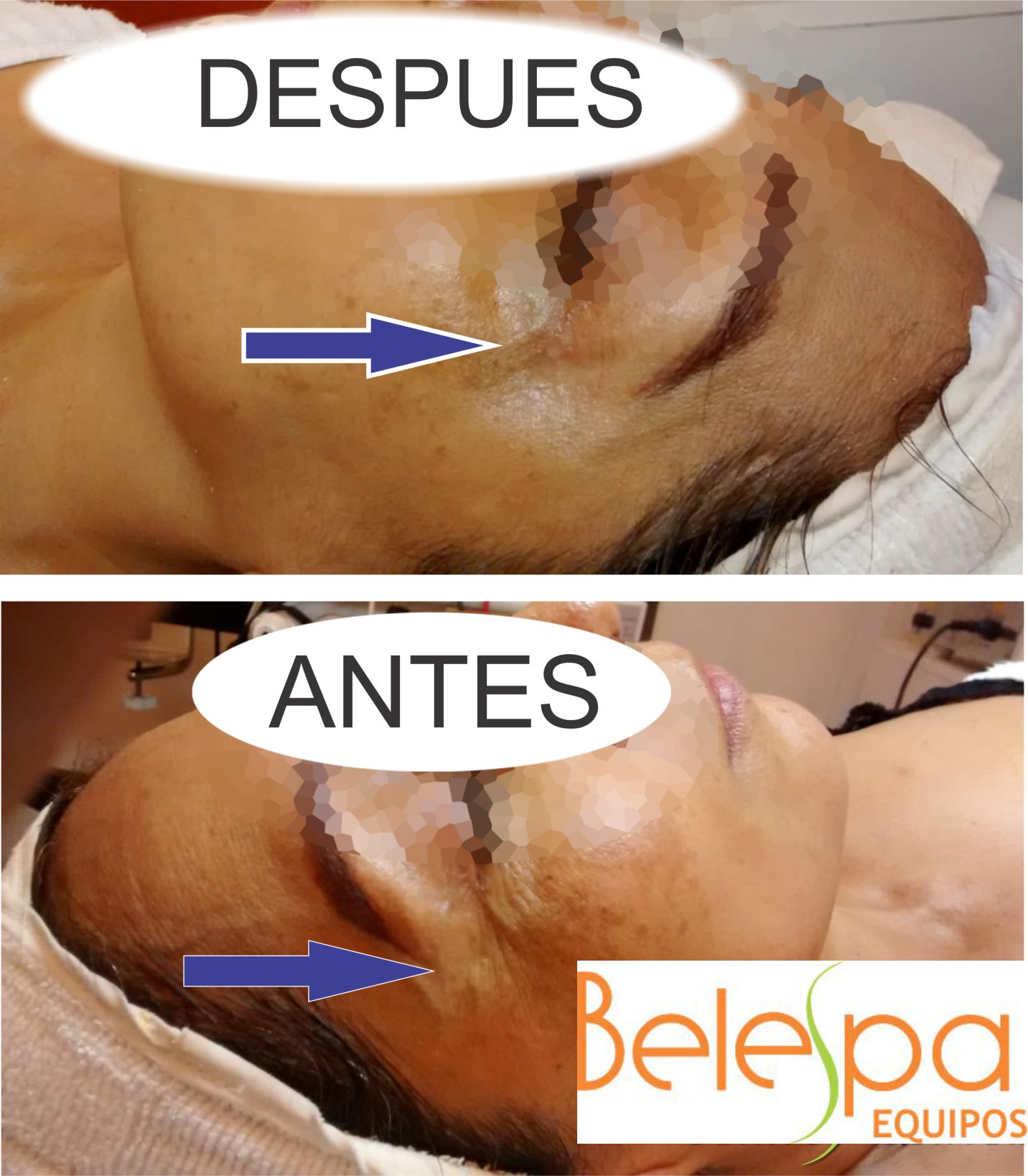 Mini Hifu Portatil Rejuvenecimiento Lifting  Facial 