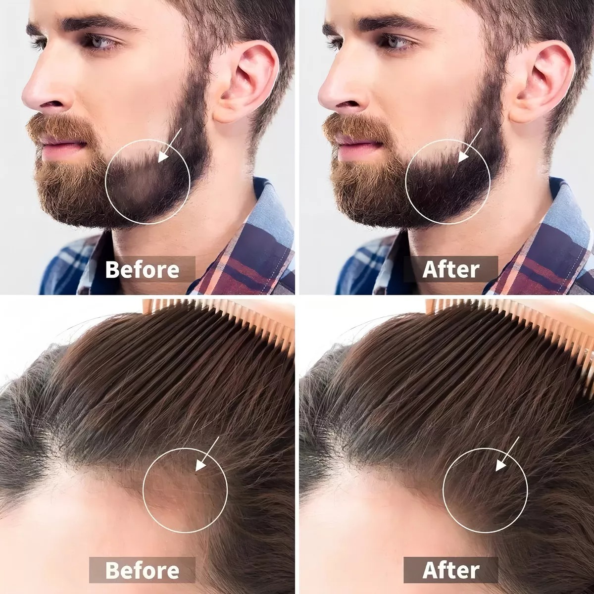 Shzhdikun 0.5mm 1200 Microagujas Dermaroller Hair Roller Barba Cabello