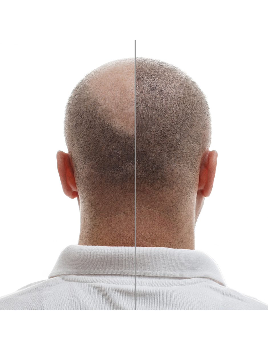 Minoxidil 1mg 100 tabletas Minoxihead