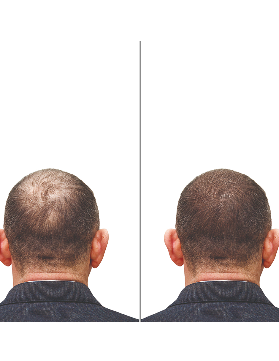 Minoxidil 1mg 100 tabletas Minoxihead
