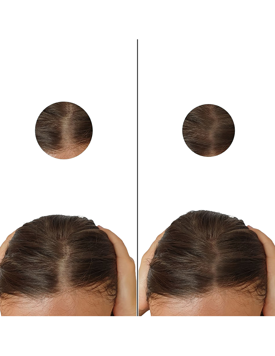 Minoxidil 1mg 100 tabletas Minoxihead