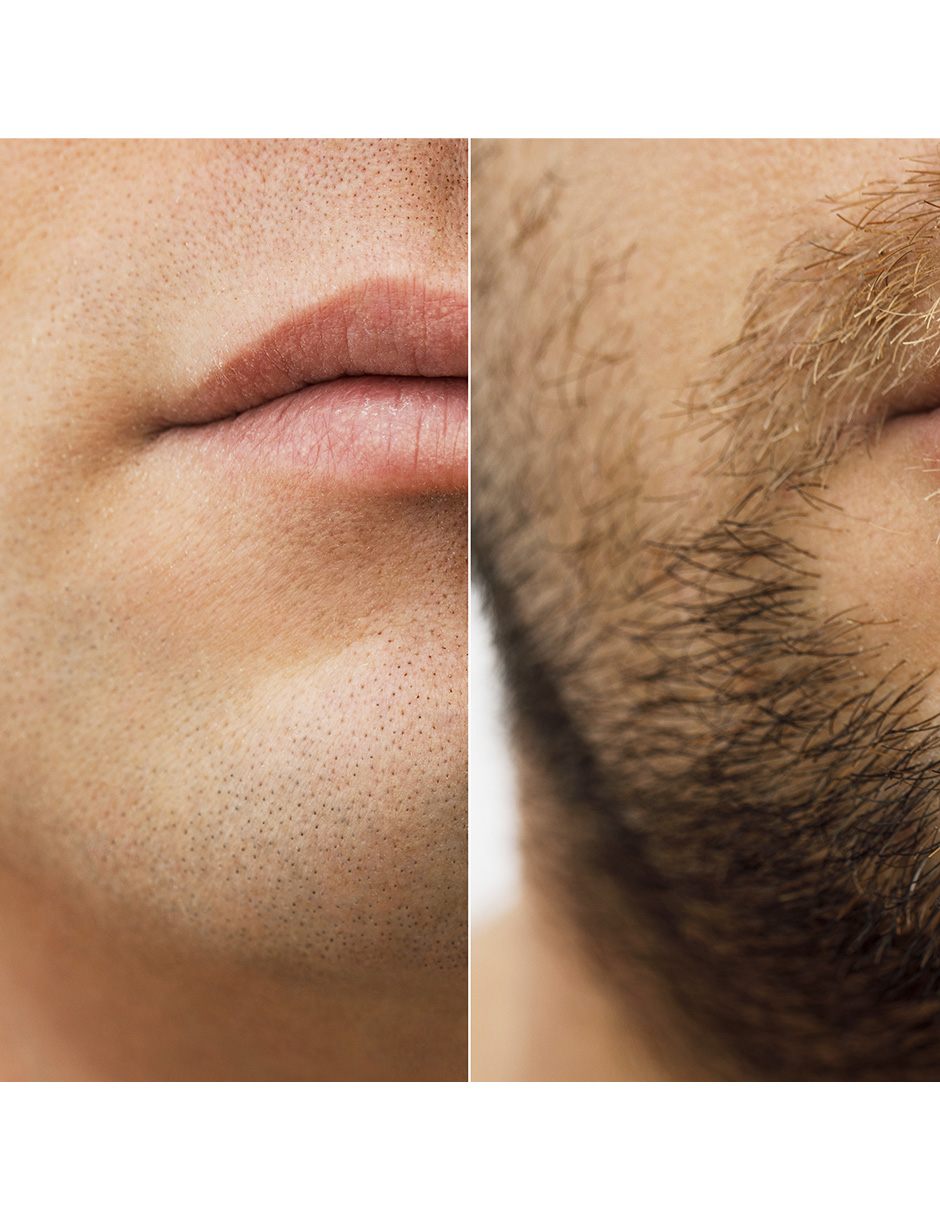 Minoxidil 2.5mg 50 Tabletas Minoxytop